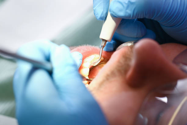 Best Emergency Treatment for Dental Infections or Abscesses in Schriever, LA